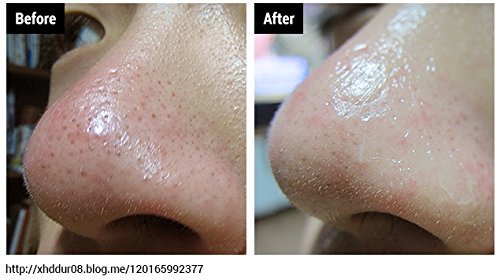 Image result for skinmiso 3 Step Blackhead Remover